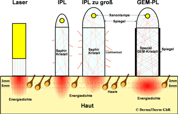 Laser IPL GEM vergelijking